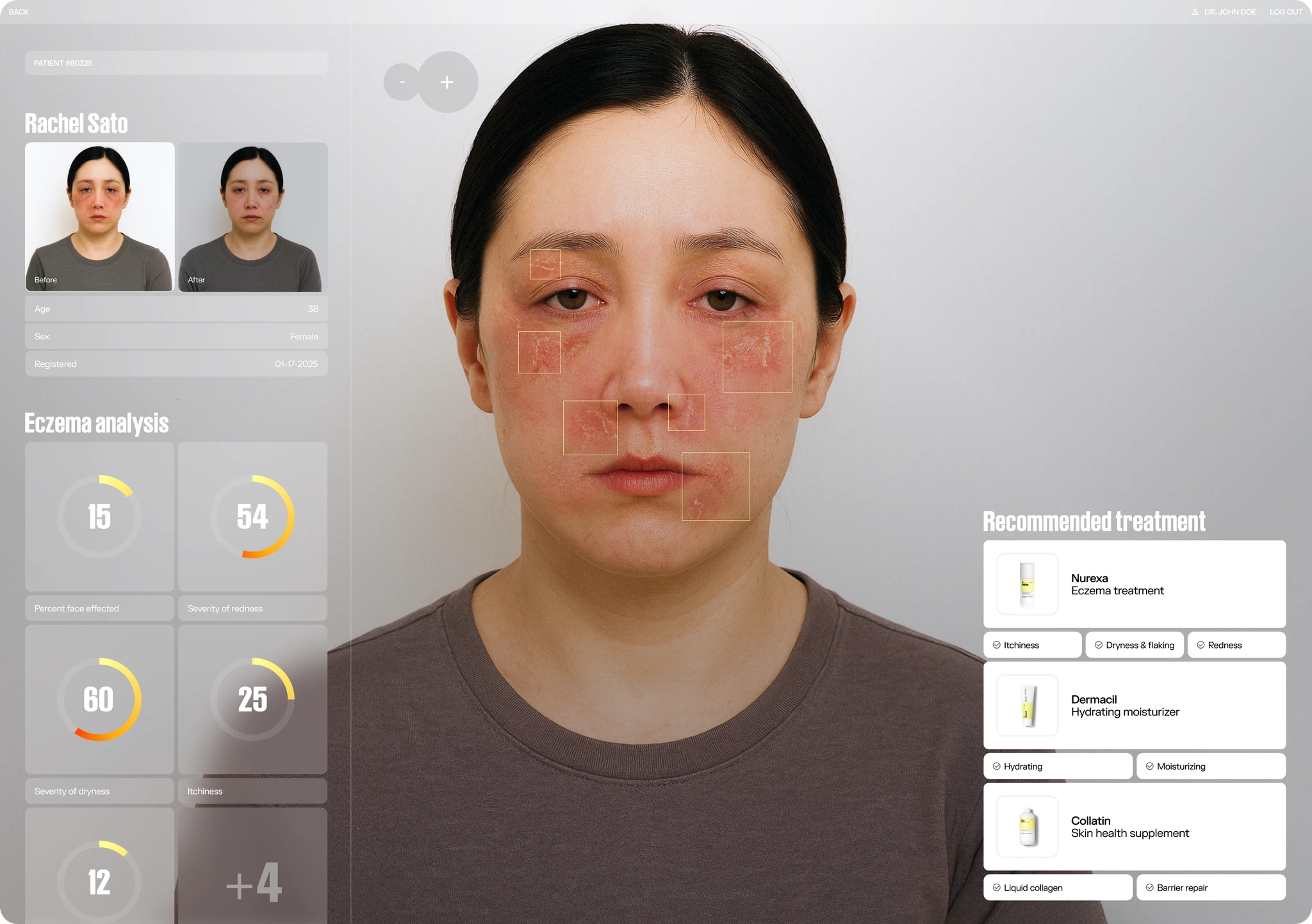 Eczema Before